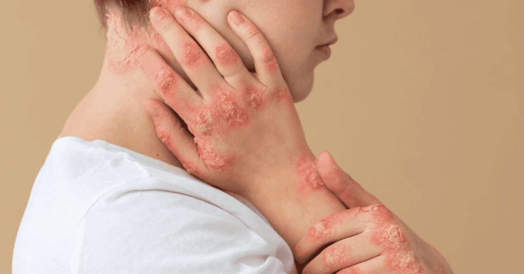 dermatomiositis
